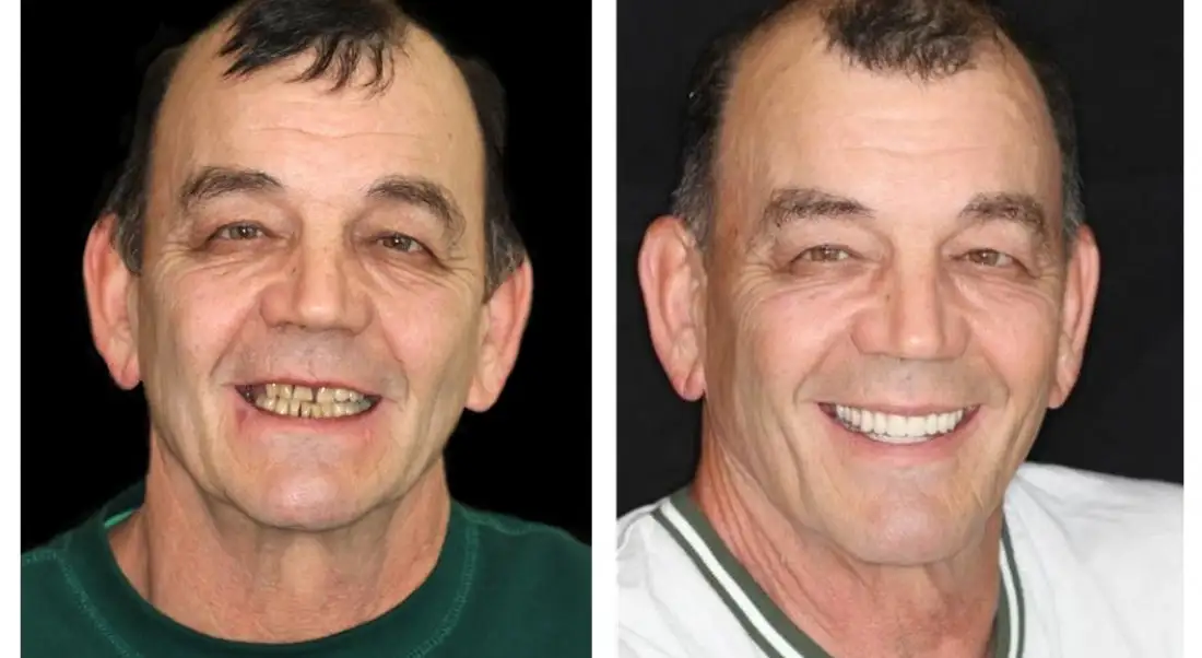 🦷Advanced Customized Full Denture Set🦷🇺🇸 (⏰Limited time discount last 30 minutes⏰) - Image 11