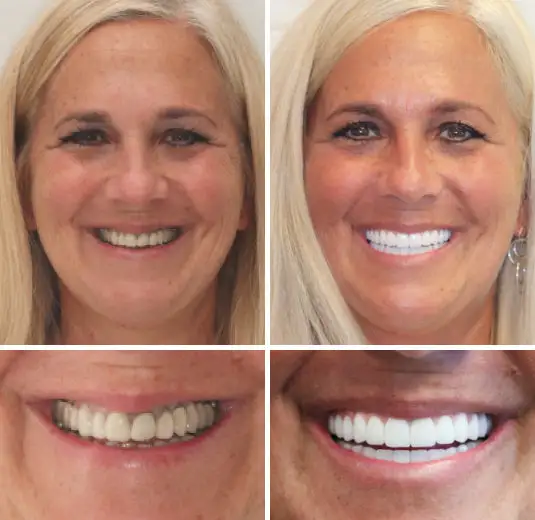 🦷Advanced Customized Full Denture Set🦷🇺🇸 (⏰Limited time discount last 30 minutes⏰) - Image 6