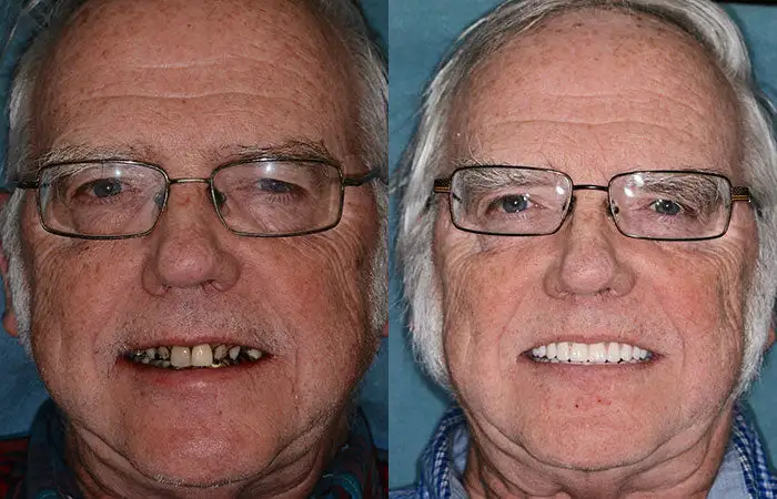 🦷Advanced Customized Full Denture Set🦷🇺🇸 (⏰Limited time discount last 30 minutes⏰) - Image 9