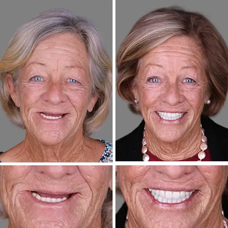 (Affordable --Advanced Customized Full Denture Set🦷 - Image 9