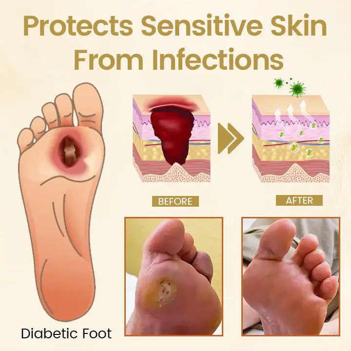 Bee Venom Diabetic Foot Healing Spray - Image 16