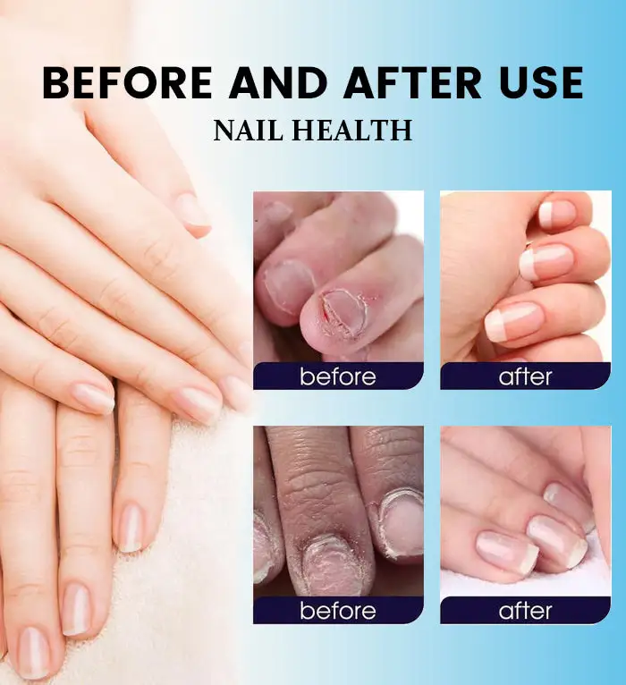 Nail Fungus Laser Treatment Device - Image 12