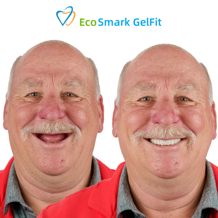 GelFit Dentures - Image 3