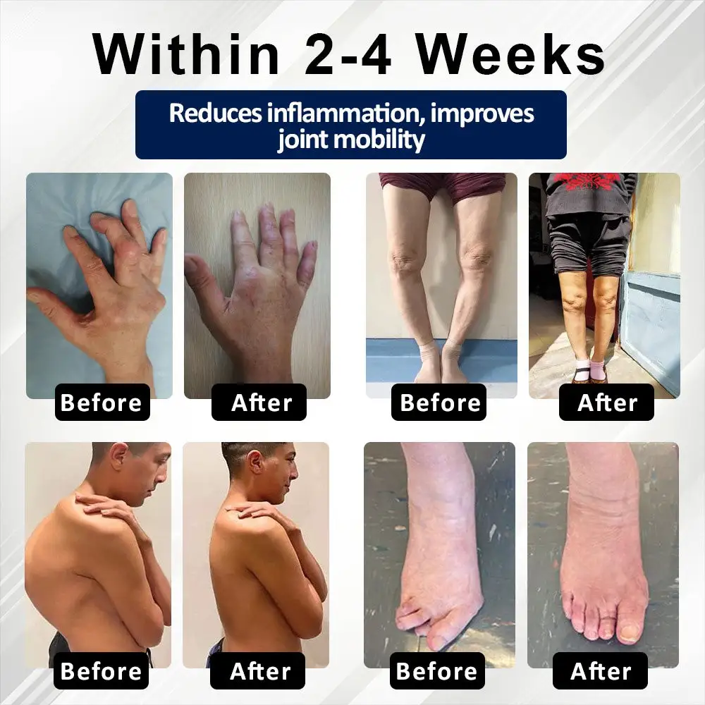 BeeEase MicroSting Joint Patches - Image 3