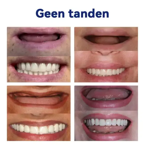 Geavanceerde op maat gemaakte volledige protheseset🌸 - Image 13