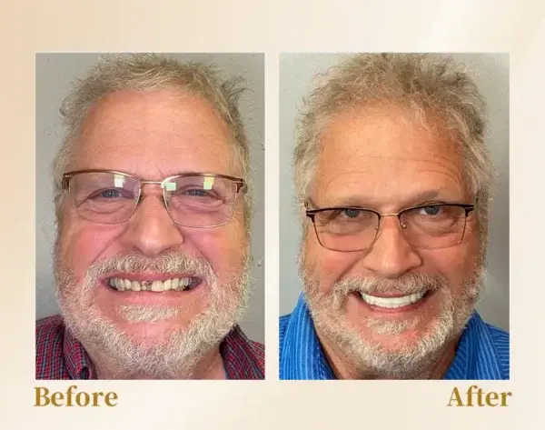 –🦷Advanced Customized Full Denture Set🦷 (⏰Limited time discount last 30 minutes⏰)💎💎 - Image 11