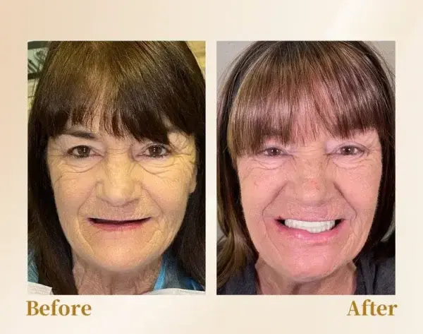 🦷Advanced Customized Full Denture Set🦷 (⏰Limited time discount last 30 minutes⏰)🚁🚁 - Image 10