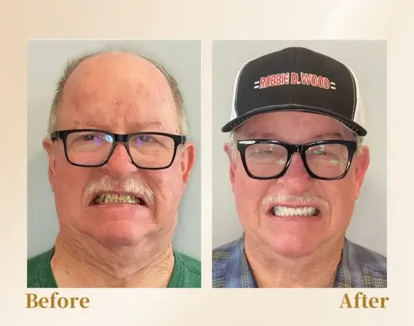 🦷Advanced Customized Full Denture Set🦷 (⏰Limited time discount last 30 minutes⏰)🚁🚁 - Image 5