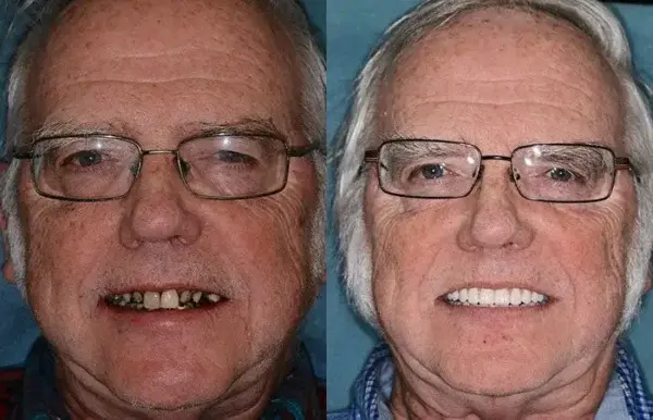 Full Denture Setš¦·š¦·šAdvanced Self-Adjusting Dental Materials (ā°Limited time discount last 30 minutesā°) - Image 8