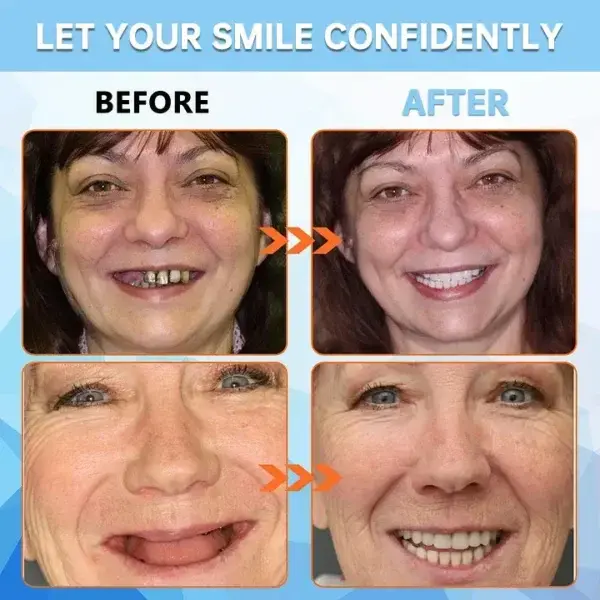 Adsorptive Dentures - Image 8