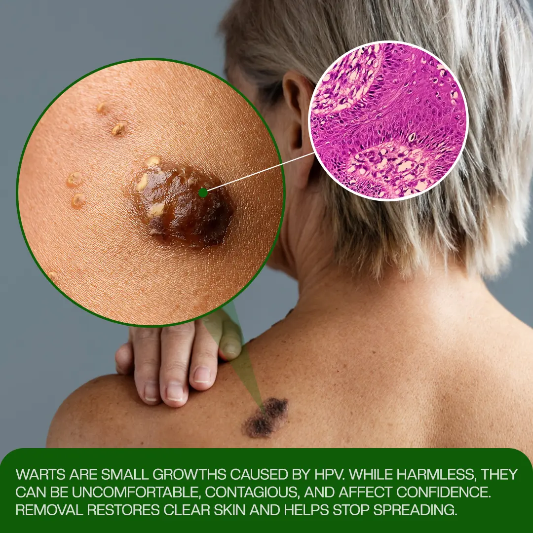 Wart Remover Patch - Image 5