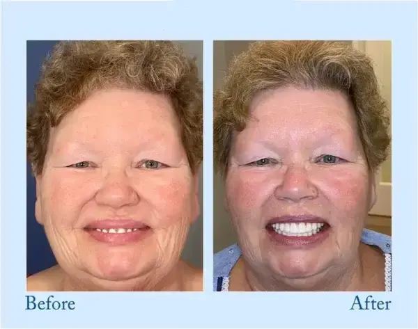 TrueEase Dentures - Image 11