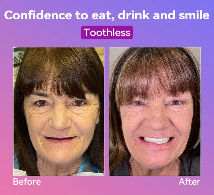 Latest Premium Comfort Dentures - Image 6