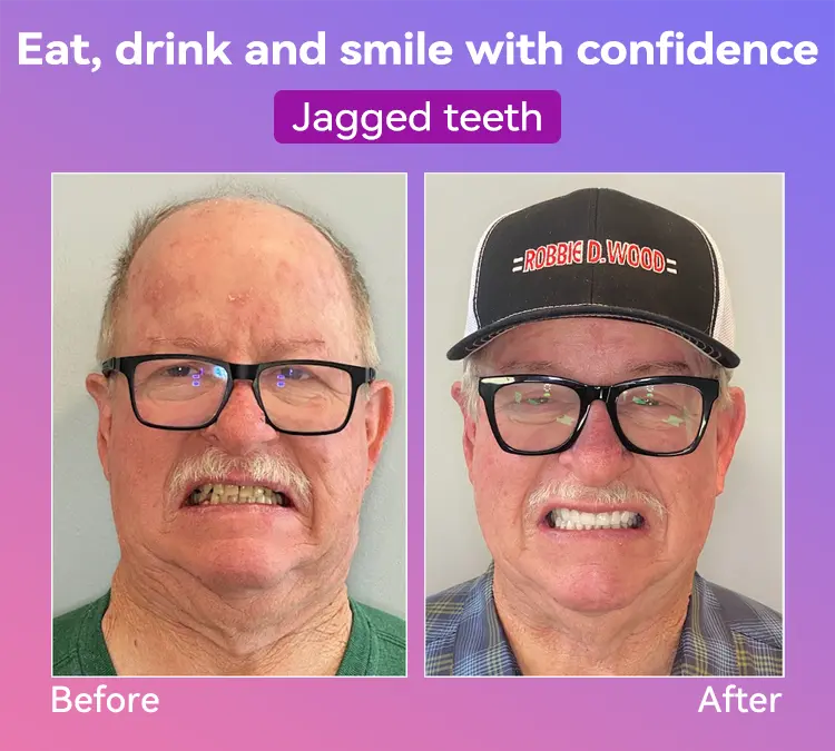 Latest Premium Comfort Dentures - Image 7