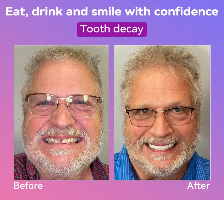 Latest Premium Comfort Dentures - Image 4