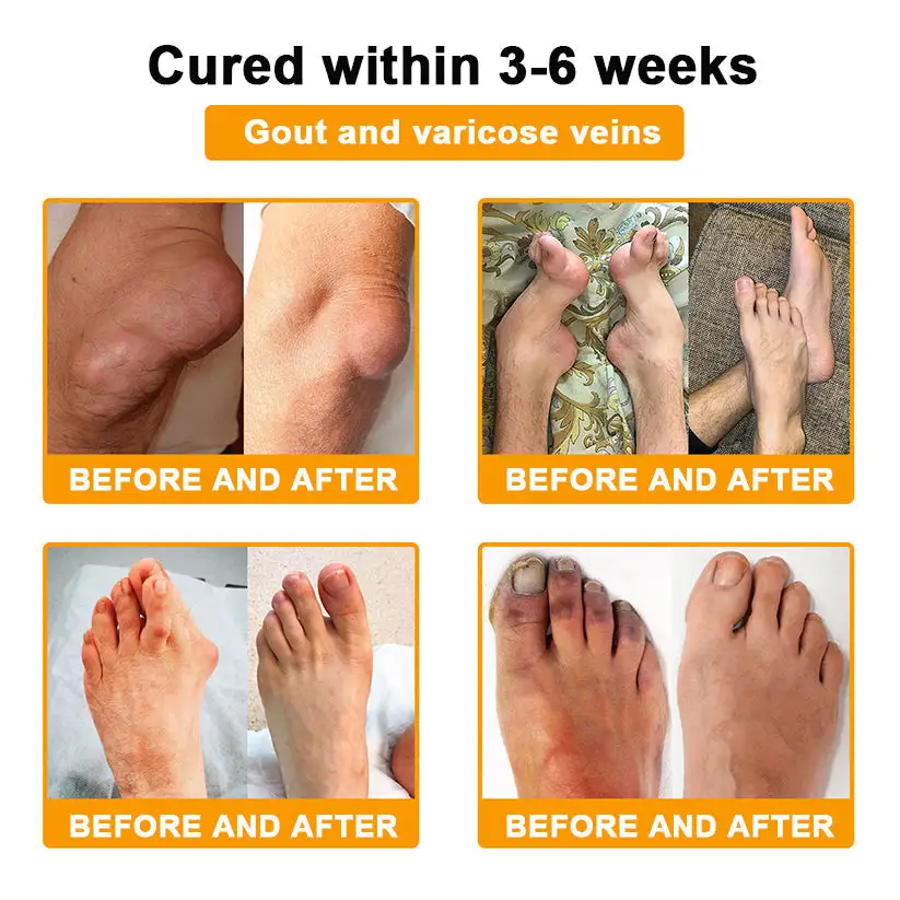 Botulinum Toxin & Bee Venom Pain-Relief Bone Healing Cream - Image 4