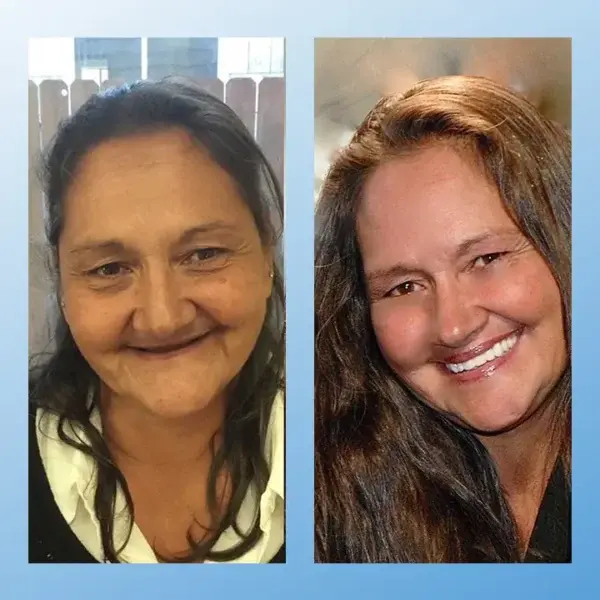 Functional Dentures - Image 4