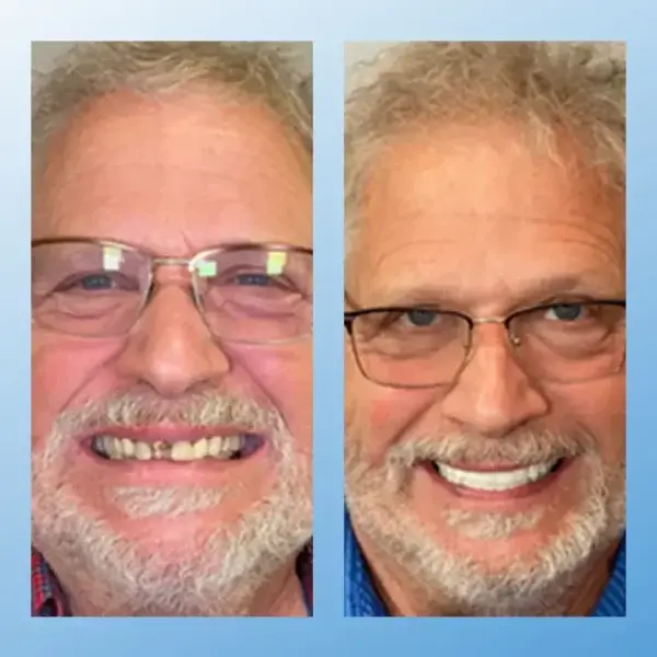 Functional Dentures - Image 5