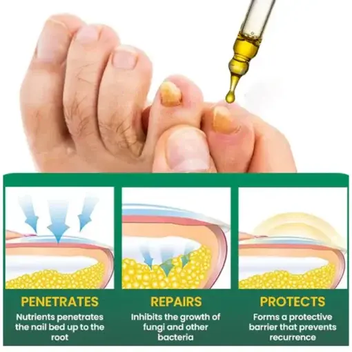 Fungal Nail Treatment - Image 3