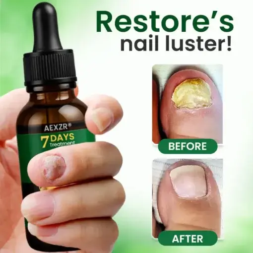 Fungal Nail Treatment - Image 6