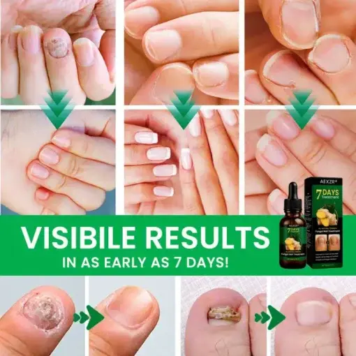 Fungal Nail Treatment - Image 7