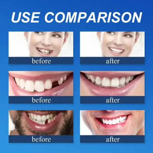 (Affordable –Advanced Customized Full Denture Set🦷 - Image 10