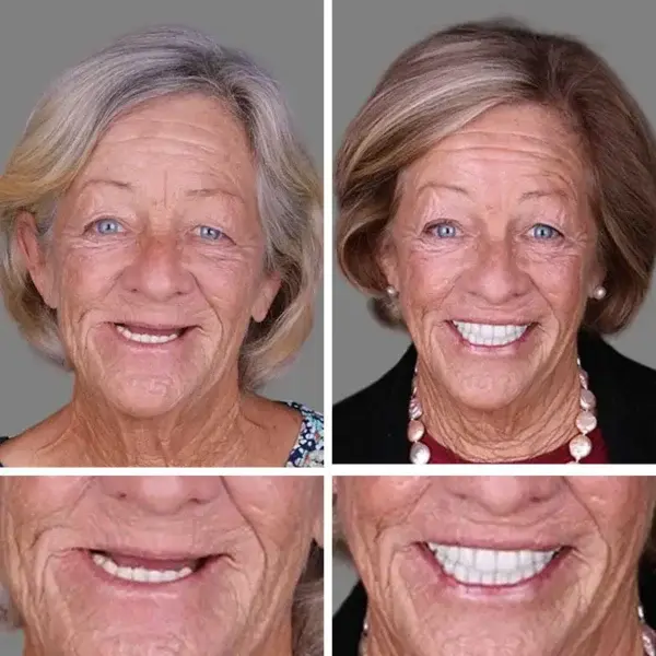 (Affordable –Advanced Customized Full Denture Set🦷 - Image 9