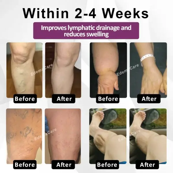 EdemaRelief Lymphatic Detox Cream - Image 2