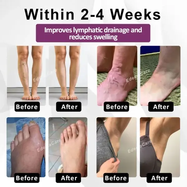 EdemaRelief Lymphatic Detox Cream - Image 3