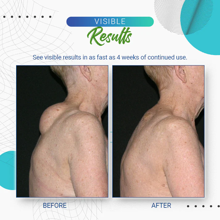 Lipoma Removal Cream - Image 6