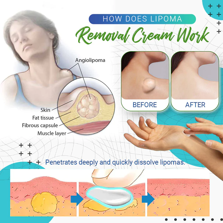 Lipoma Removal Cream - Image 7
