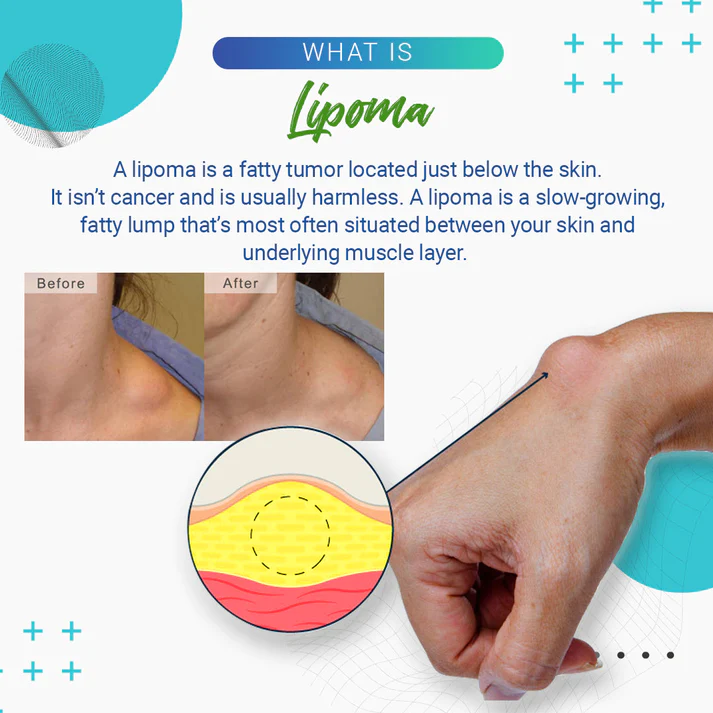 Lipoma Removal Cream - Image 11