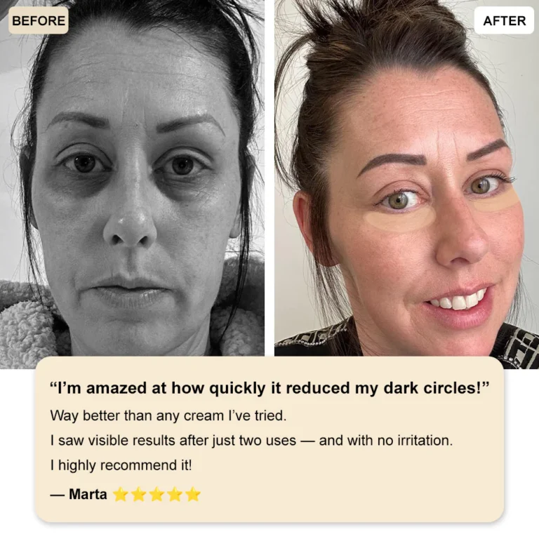 ✅Official Store: Deep Precision Age-Defying Nano Microneedle Patches – Deep-acting solution for tackling under-eye bags, dark circles, laughter lines, forehead lines, and all those other pesky facial wrinkles. - Image 4