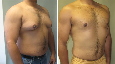 Gynecomastia Cream - Image 4