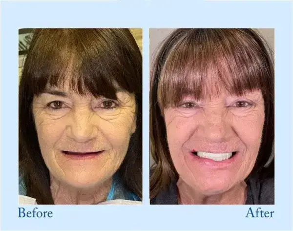 🦷Advanced Customized Full Denture Set🦷 (⏰Limited time discount last 30 minutes⏰)💎 - Image 6