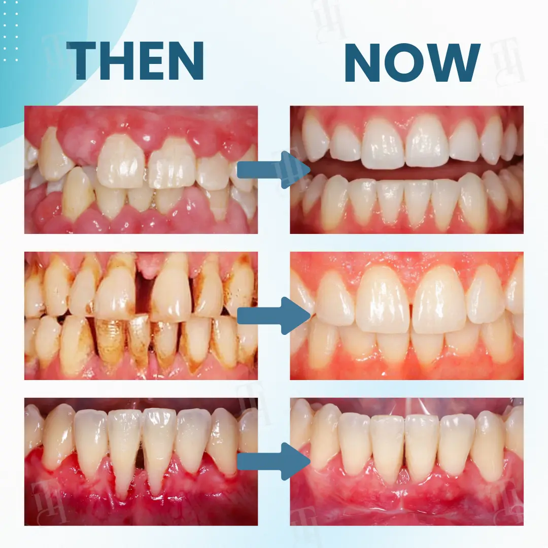 Makesmile Bee Venom Oral Treatment Powder - Image 4