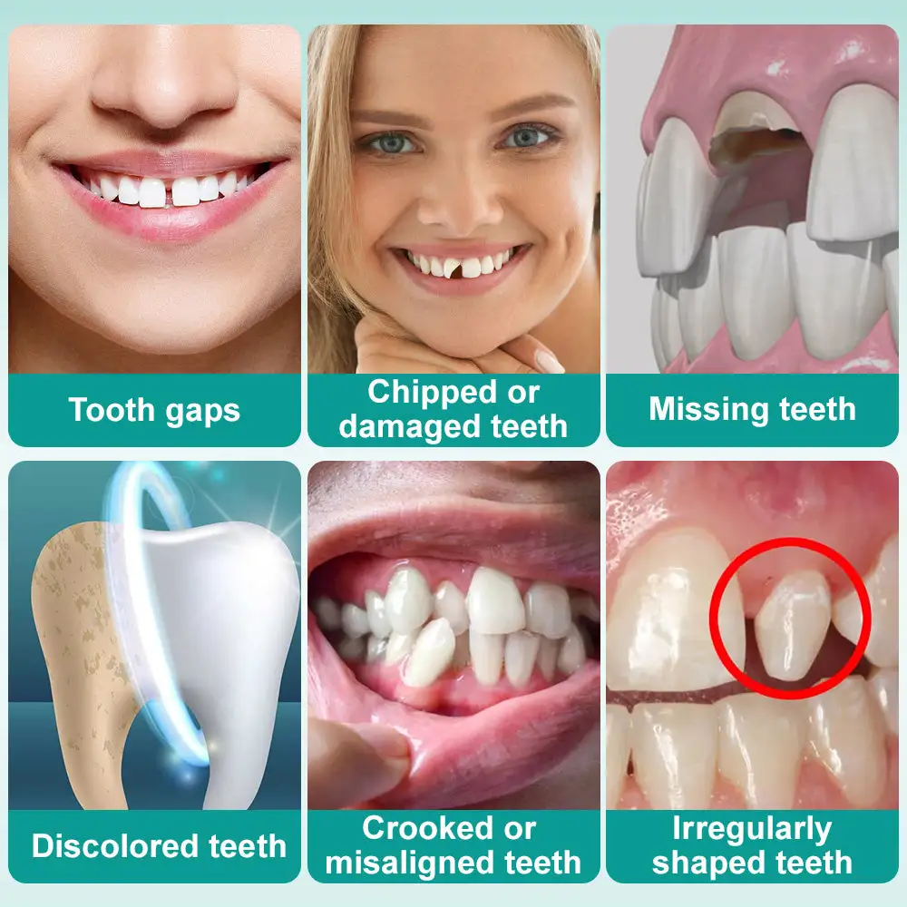 ๐๐ป๐๐๐ฎ๐ป๐ ๐ฆ๐๐ถ๐ฐ๐ธ-๐ผ๐ป ๐๐ฒ๐ป๐๐ฎ๐น ๐ฉ๐ฒ๐ป๐ฒ๐ฒ๐ฟ๐ (โ
Clinically proven, easy-to-use dental veneers trusted by over 8,000 US users for a comfortable, natural smile.) - Image 8