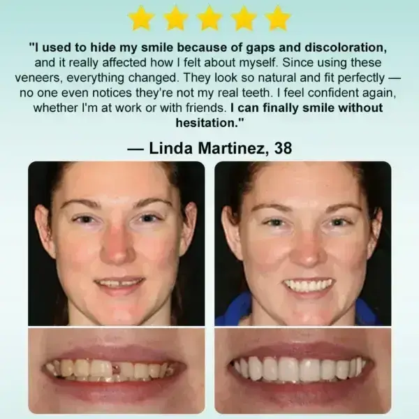 ๐๐ป๐๐๐ฎ๐ป๐ ๐ฆ๐๐ถ๐ฐ๐ธ-๐ผ๐ป ๐๐ฒ๐ป๐๐ฎ๐น ๐ฉ๐ฒ๐ป๐ฒ๐ฒ๐ฟ๐ (โ
Clinically proven, easy-to-use dental veneers trusted by over 8,000 US users for a comfortable, natural smile.) - Image 4