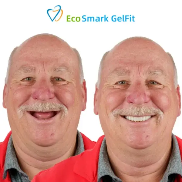 EcoSmark GelFit Dentures - Image 2
