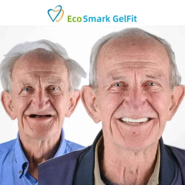 EcoSmark GelFit Dentures - Image 3