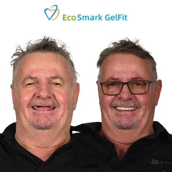 EcoSmark GelFit Dentures - Image 5