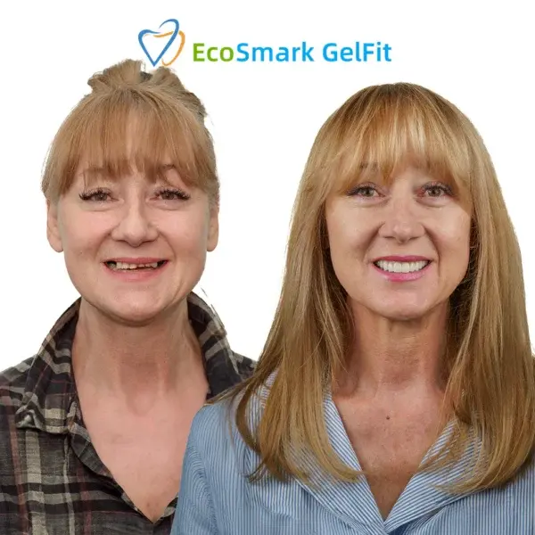 EcoSmark GelFit Dentures - Image 6