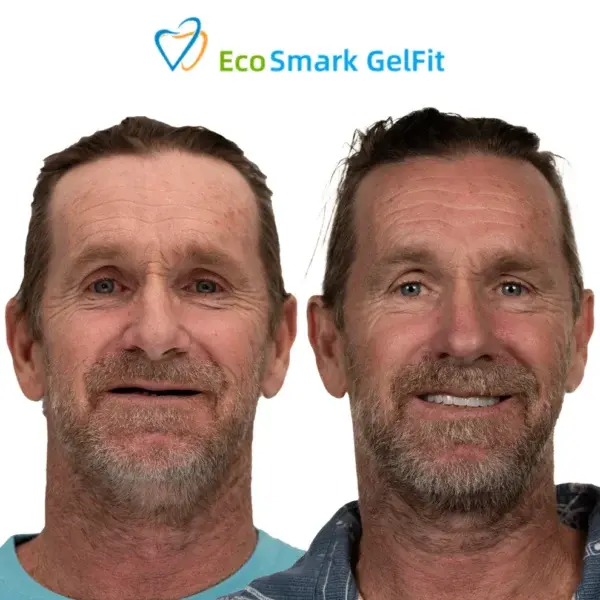 EcoSmark GelFit Dentures - Image 7