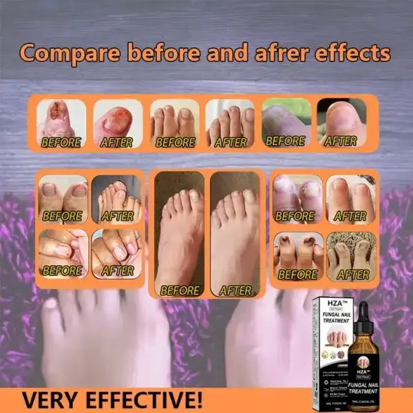 Fungal Nail Treatment - Image 6