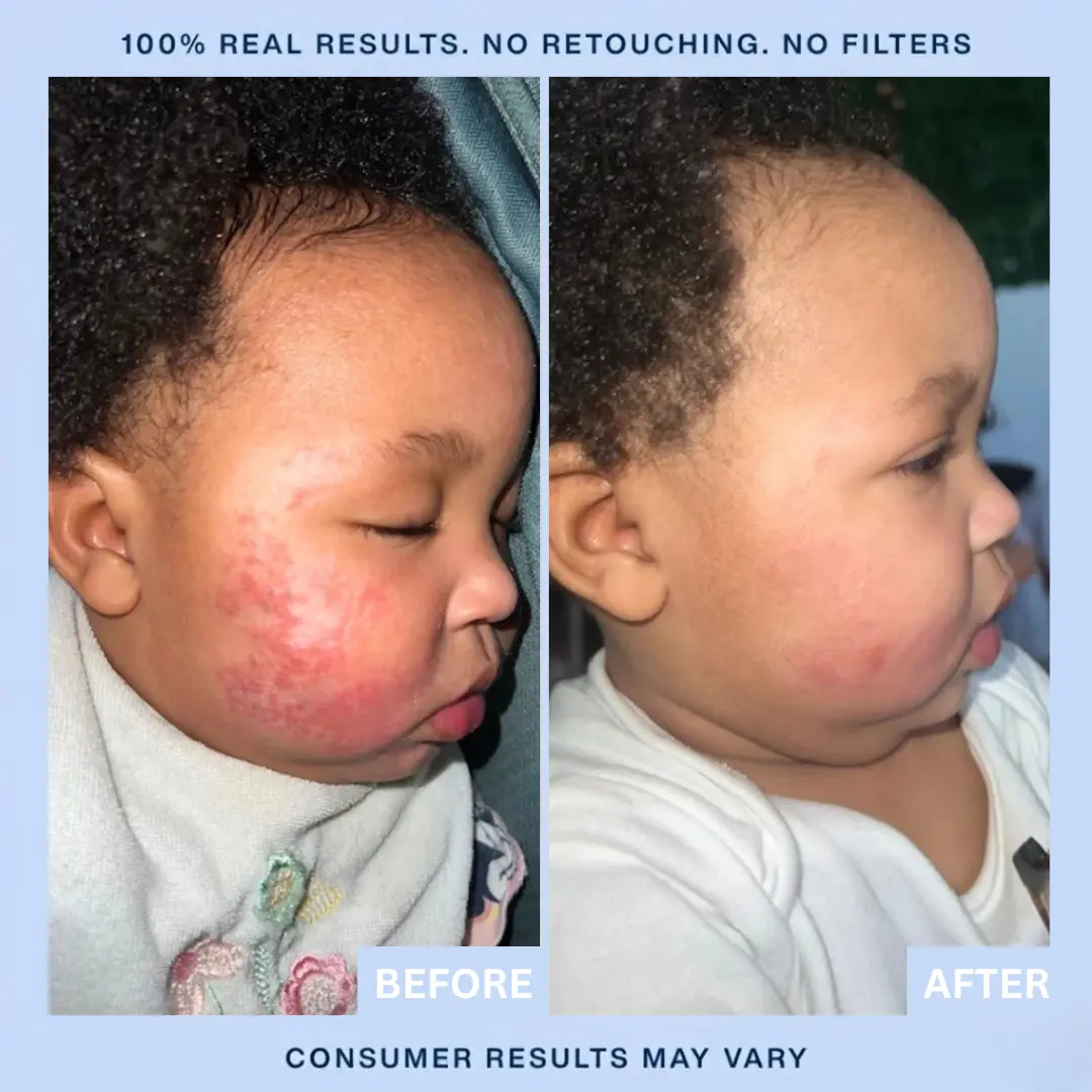 Eczema & Psoriasis Cream - Image 3