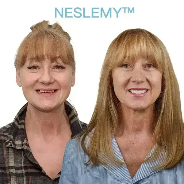 GelFit Dentures - Image 4