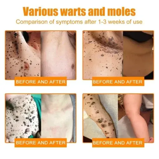 Bee Venom Wart & Tag Removal Cream - Image 5