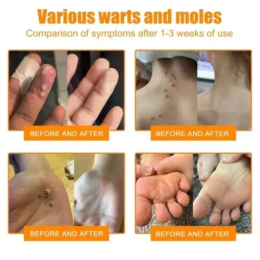 Bee Venom Wart & Tag Removal Cream - Image 6
