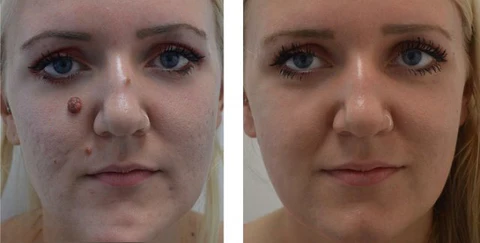 DR. JOYIAU BEE VENOM Warts & Spots Removal Cream - Image 3