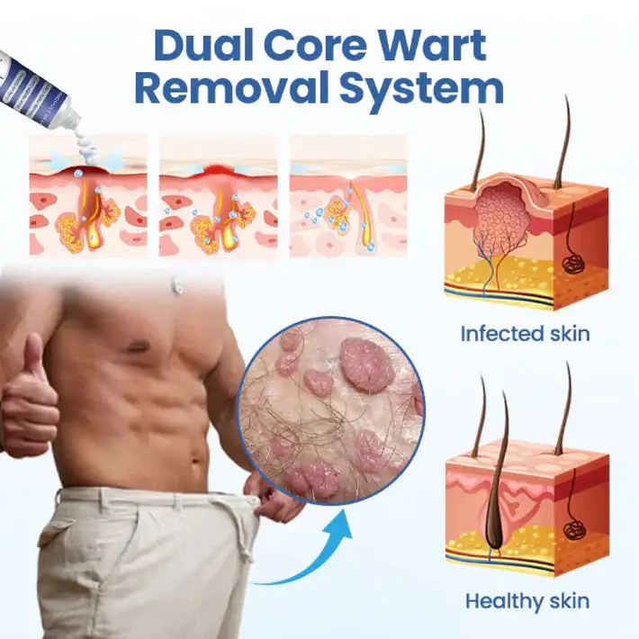 WartRelief Cream - Image 5